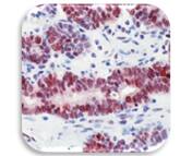 IHC Image of MGMT