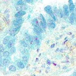 IHC image showing PD-L1 expression in green and PD-1 mRNA expression in red in human lung cancer.