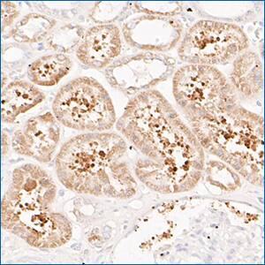 FBPase1 antibody staining of human kidney liver cancer tissue, IHC. FBPase1 immunohistochemical staining of paraffin-embedded human kidney tissue using rabbit monoclonal anti-FBPase1 antibody, detected with HRP-DAB substrate, and counter-stained with hematoxylin.