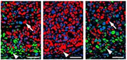 MAPK, NOTCH expression human colon cancer model