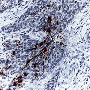 Immunohistochemical detection of cleaved caspase-3 in human colon cancer tissue using anti-cleaved caspase-3 antibody and detected with anti-IgG HRP antibody followed by staining with DAB and counterstaining with hematoxylin.