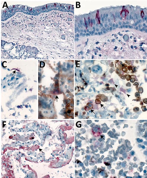 Tissue and cellular distribution of SARS-CoV-2 viral particles analyzed by IHC with Rabbit Anti-SARS-CoV nucleocapsid polyclonal antibody identifying presence of virus in upper respiratory tissues, pneumocytes, macrophages, hyaline membranes from fatal cases.