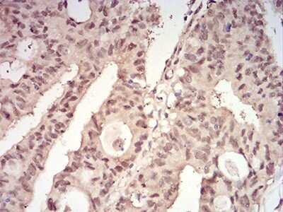 Immunohistochemistry: 14-3-3 beta/alpha Antibody (5B5G10) [NBP2-61780] - Analysis of paraffin-embedded rectum cancer tissues using YWHAB mouse mAb with DAB staining.