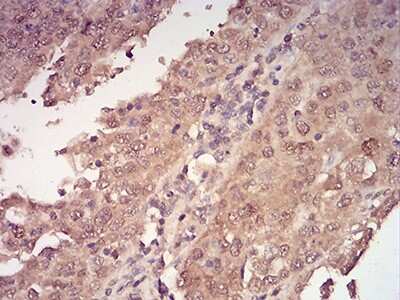 Immunohistochemistry: 14-3-3 beta/alpha Antibody (5B5G10) [NBP2-61780] - Analysis of paraffin-embedded endometrial cancer tissues using YWHAB mouse mAb with DAB staining.