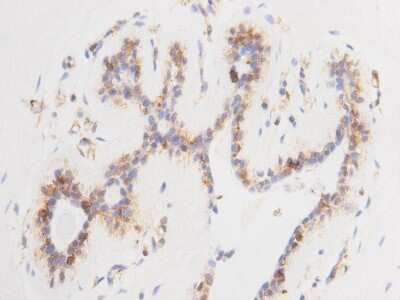 Immunohistochemistry-Paraffin: 14-3-3 beta/alpha Antibody (9-26) [NBP2-67090] - Analysis of paraffin- embedded human breast carcinoma tissue using anti-14-3-3b/a Mouse mAb.