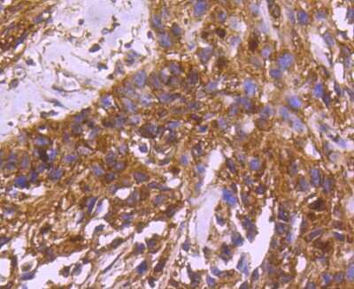 Immunohistochemistry-Paraffin: 14-3-3 beta/alpha Antibody (SD0837) [NBP2-67833] - Analysis of paraffin-embedded human breast carcinoma tissue using anti-14-3-3 alpha+beta antibody. Counter stained with hematoxylin.