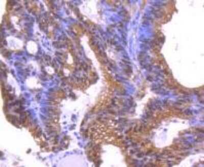 Immunohistochemistry-Paraffin: 14-3-3 epsilon Antibody (JJ08-40) [NBP2-67834] - Analysis of paraffin-embedded human colon cancer tissue using anti-14-3-3 epsilon antibody. Counter stained with hematoxylin.