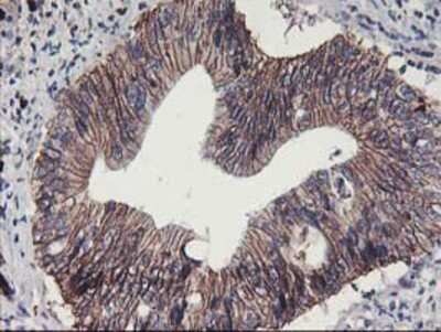 Immunohistochemistry-Paraffin: 15-Lipoxygenase 1 Antibody (OTI3G8) [NBP2-01740] -  Staining of paraffin-embedded Carcinoma of Human pancreas tissue using anti-15 Lipoxygenase 1 mouse monoclonal antibody.