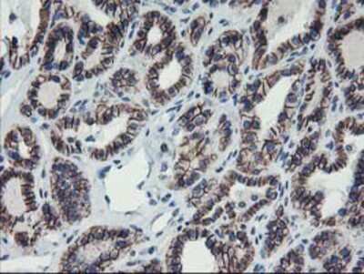 Immunohistochemistry-Paraffin: 15-Lipoxygenase 1 Antibody (OTI3G8) [NBP2-01740] - Staining of paraffin-embedded Carcinoma of Human thyroid tissue using anti-15 Lipoxygenase 1 mouse monoclonal antibody.