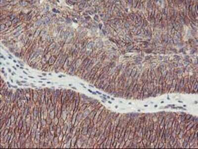 Immunohistochemistry: 15-Lipoxygenase 1 Antibody (OTI3G8) - Azide and BSA Free [NBP2-70169] - Staining of paraffin-embedded Carcinoma of Human bladder tissue using anti-15 Lipoxygenase 1 mouse monoclonal antibody.