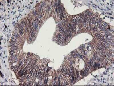 Immunohistochemistry: 15-Lipoxygenase 1 Antibody (OTI3G8) - Azide and BSA Free [NBP2-70169] - Staining of paraffin-embedded Carcinoma of Human pancreas tissue using anti-15 Lipoxygenase 1 mouse monoclonal antibody.