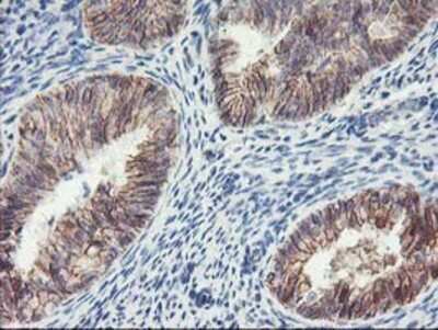 Immunohistochemistry: 15-Lipoxygenase 1 Antibody (OTI3G8) - Azide and BSA Free [NBP2-70169] - Staining of paraffin-embedded Adenocarcinoma of Human endometrium tissue using anti-15 Lipoxygenase 1 mouse monoclonal antibody.