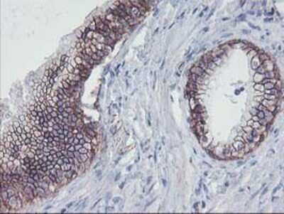 Immunohistochemistry: 15-Lipoxygenase 1 Antibody (OTI3G8) - Azide and BSA Free [NBP2-70169] - Staining of paraffin-embedded Carcinoma of Human prostate tissue using anti-15 Lipoxygenase 1 mouse monoclonal antibody.