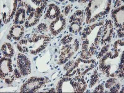 Immunohistochemistry: 15-Lipoxygenase 1 Antibody (OTI3G8) - Azide and BSA Free [NBP2-70169] - Staining of paraffin-embedded Carcinoma of Human thyroid tissue using anti-15 Lipoxygenase 1 mouse monoclonal antibody.