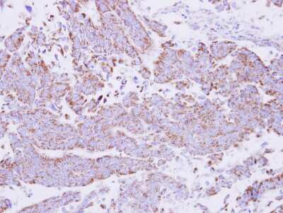 Immunohistochemistry-Paraffin: 15-PGDH/HPGD Antibody [NBP2-21588] -  Human colon carcinoma, using 15-PGDH antibody at 1:500 dilution. Antigen Retrieval: Trilogy™ (EDTA based, pH 8.0) buffer, 15min.