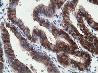 Immunohistochemistry: 15-PGDH/HPGD Antibody (OTI2C10) - Azide and BSA Free [NBP2-70933] - Staining of Adenocarcinoma of Human endometrium tissue using anti-15-PGDH mouse monoclonal antibody.