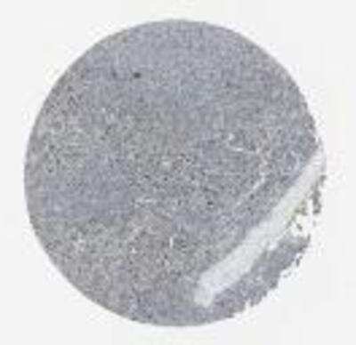 Immunohistochemistry: GPR172B Antibody [19540002] - Lymphomas and malignant gliomas were moderately stained in cytoplasm whilst their normal counterparts were negative.  Image was provided courtesy of the Swedish Human Proteome Resource (HPR) Center.