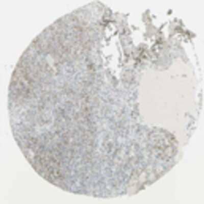 Immunohistochemistry: GPR172B Antibody [19540002] - Normal and tumor tissues showed a moderate cytoplasmic staining. Strong cytoplasmic immunoreactivity was found in normal glandular cells. Tumor tissues showed moderate cytoplasmic positivity except renal carcinoma and cutaneous malignancies which were negative. Occasional cases of thyroid tumors, malignant melanoma and urothelial carcinoma displayed strong cytoplasmic staining. Lymphomas and malignant gliomas were moderately stained in cytoplasm whilst their normal counterparts were negative.   Image and statement courtesy of the Human Protein Atlas (HPA).