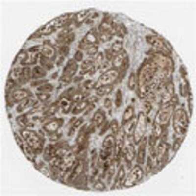 Immunohistochemistry: SUR1 Antibody [19600002] - Strong membranous staining pattern observed in colo-rectal cancers by immunohistochemistry.  Image is provided courtesy of the Swedish Human Proteome Resource (HPR) Center.