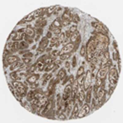 Immunohistochemistry: SUR1 Antibody [19600002] - Most normal tissues exhibited moderate to strong cytoplasmic expression. Membranous staining pattern was seen in the intestinal tissues. Strong cytoplasmic immunoreactivity was observed in salivary gland, exocrine pancreas, skeletal muscle and non-follicle cells of lymph node. Purkinje cells and adrenal cortical cells demonstrated strong nuclear positivity. Malignant tissues generally displayed weak to moderate cytoplasmic expression. Strong membranous staining pattern was observed in colo-rectal cancers. Nuclear staining was mainly seen in non-Hodgkin's lymphomas, urothelial cancers and malignant gliomas.  Image and statement courtesy of the Human Protein Atlas (HPA).