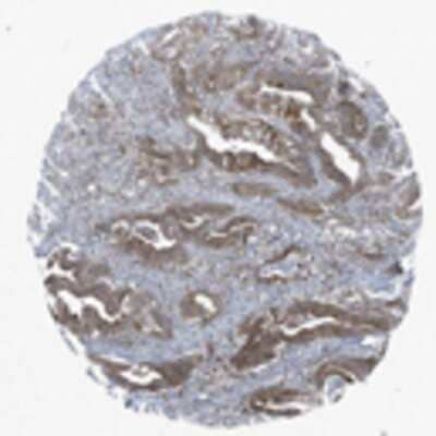 Immunohistochemistry: AP3M2 Antibody [21070002] - Normal tissues showed moderate to strong cytoplasmic staining. Gastro-intestinal glandular cells, hepatocytes and the thyroid exhibited strong staining. The malignant tissues displayed mainly moderate positivity. Strong staining was observed in most cases of colo-rectal cancers but also observed in occasional cases of other malignancies. Skin cancers generally displayed weak staining.  Image and statement courtesy of the Human Protein Atlas (HPA).