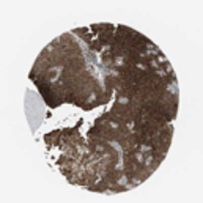 Immunohistochemistry: SPFH2 Antibody [21320002] - Strong cytoplasmic staining, most likely located in the endoplasmatic reticulum, was observed in a majority of normal and malignant tissues. Many cases of non-Hodgkin's lymphoma were negative.  Image and statement courtesy of the Human Protein Atlas (HPA).