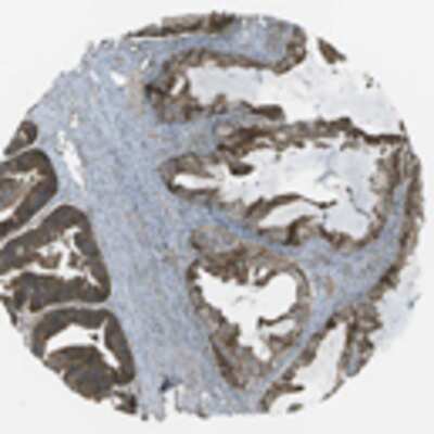 Immunohistochemistry: PROSC Antibody [21730002] - A majority of the normal cells displayed moderate to strong cytoplasmic positivity. Most of the malignant cells showed moderate cytoplasmic immunoreactivity. A few cases of ovarian cancers were strongly stained while most cases of melanomas and lymphomas were weakly positive.  Image and statement courtesy of the Human Protein Atlas (HPA).