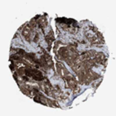 Immunohistochemistry: Cathepsin V Antibody [23400002] - Normal tissues showed moderate to strong, often granular, cytoplasmic staining. The strongest staining was observed in cytoplasm and extra cellular material of thyroid gland. Malignant tissues were generally moderately stained. Malignant gliomas, colo-rectal, endometrial and hepatocellular malignancies showed strong cytoplasmic staining in a few cases. Malignant lymphomas and lung cancers were generally weakly stained.  Image and statement courtesy of the Human Protein Atlas (HPA).