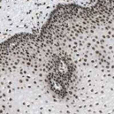 Immunohistochemistry: CUL4B Antibody [25150002] - Most of the normal and malignant tissues showed moderate to strong nuclear staining with an additional weak cytoplasmic positivity. Normal liver was negative. Most hepatocellular carcinomas were weakly stained.  Image and statement courtesy of the Human Protein Atlas (HPA).