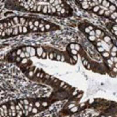 Immunohistochemistry: Dfna5 Antibody [28490002] - Most of the normal cells showed strong cytoplasmic positivity. Glial cells displayed moderate cytoplasmic staining in a fraction of cells. A majority of the malignant cells displayed moderate cytoplasmic immunoreactivity. Several cases of lymphomas, melanomas, thyroid, colorectal, ovarian, endometrial cancers and cholangiocarcinomas showed strong positivity.  Image and statement courtesy of the Human Protein Atlas (HPA).