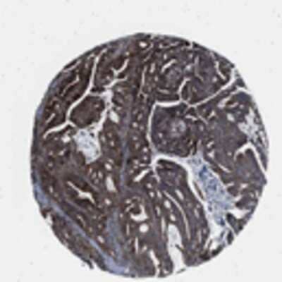 Immunohistochemistry: MYO5C Antibody [32190002] - Strong cytoplasmic and/or membranous staining pattern observed in endometrial cancer tissue by immunohistochemistry.  Image is provided courtesy of the Swedish Human Proteome Resource (HPR) Center.