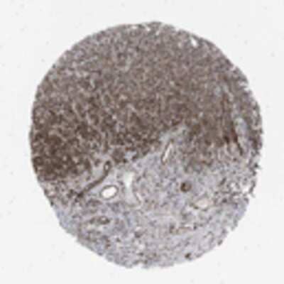 Immunohistochemistry: MYO5C Antibody [32190002] - Strong cytoplasmic and/or membranous staining pattern observed in head and neck cancer tissue, squamous cell carcinoma, by immunohistochemistry.  Image is provided courtesy of the Swedish Human Proteome Resource (HPR) Center.