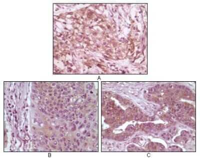 Immunohistochemistry-Paraffin: 4EBP1 Antibody (4B6G10) [NBP1-47554] - Analysis of human pancreas carcinoma (A), esophagus carcinoma tissue (B) and ovary tumor tissue (C), showing cytoplasmic and membrane localization using 4E-BP1 mouse mAb with DAB staining.