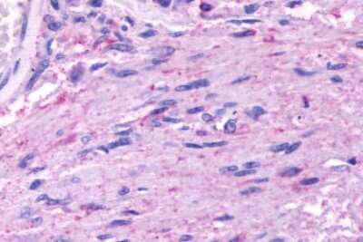 Immunohistochemistry-Paraffin: 5-HT5A Antibody [NLS2121] - Anti-HTR5A / 5-HT5A Receptor antibody IHC of human Brain, Glioblastoma. Immunohistochemistry of formalin-fixed, paraffin-embedded tissue after heat-induced antigen retrieval.
