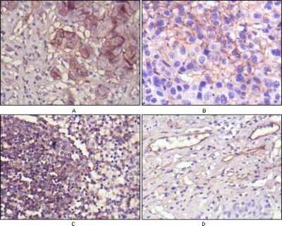 Immunohistochemistry-Paraffin: 5'-Nucleotidase/CD73 Antibody (1D7) [NBP1-47495] - Analysis of human lung cancer (A), cholangiocarcinorna (B), lymph node (C) and esophagus (D) tissues using NT5E mouse mAb with DAB staining.
