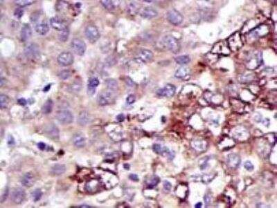 Immunohistochemistry-Paraffin: 5'-Nucleotidase/CD73 Antibody (1D7) [NBP1-47495] - Analysis of human liver cancer using 5'-Nucleotidase/CD73 antibody. EDTA was used for antigen retrieval. Image from verified customer review.
