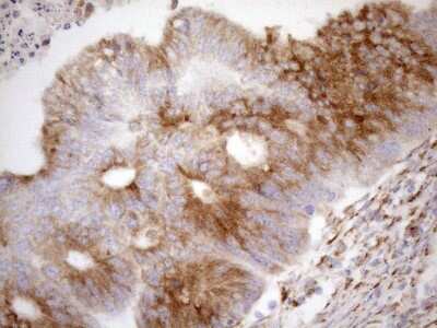 Immunohistochemistry: 5'-Nucleotidase/CD73 Antibody (1G2) [NBP2-46259] - Analysis of Adenocarcinoma of Human colon tissue. (Heat-induced epitope retrieval by 1mM EDTA in 10mM Tris buffer (pH8.5) at 120C for 3 min)