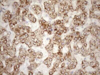 Immunohistochemistry: 5'-Nucleotidase/CD73 Antibody (1G2) [NBP2-46259] - Analysis of Carcinoma of Human liver tissue.(Heat-induced epitope retrieval by 1mM EDTA in 10mM Tris buffer (pH8.5) at 120C for 3 min)