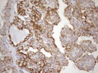 Immunohistochemistry: 5'-Nucleotidase/CD73 Antibody (1G2) [NBP2-46259] - Analysis of Carcinoma of Human thyroid tissue. (Heat-induced epitope retrieval by 1mM EDTA in 10mM Tris buffer (pH8.5) at 120C for 3 min)