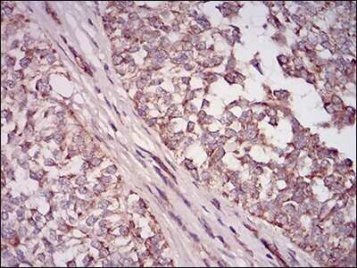 Immunohistochemistry-Paraffin: 5'-Nucleotidase/CD73 Antibody (4G6B10) [NBP2-37274] - Analysis of bladder cancer tissues using NT5E mouse mAb with DAB staining.