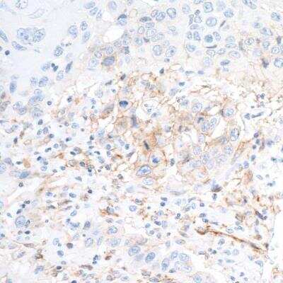 Immunohistochemistry: 5'-Nucleotidase/CD73 Antibody (BLR054F) [NBP3-14679] -  FFPE section of human head and neck squamous cell carcinoma.  Rabbit anti-CD73 recombinant monoclonal antibody used at 1:500.  HRP-conjugated goat anti-rabbit IgG.