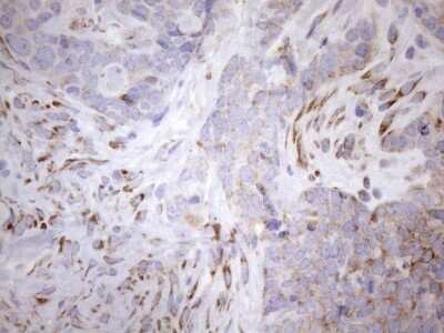 Immunohistochemistry: 5'-Nucleotidase/CD73 Antibody (OTI1G2) - Azide and BSA Free [NBP2-71214] - Analysis of Adenocarcinoma of Human endometrium tissue. (Heat-induced epitope retrieval by 1mM EDTA in 10mM Tris buffer (pH8.5) at 120C for 3 min)