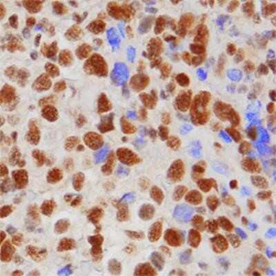 Immunohistochemistry-Paraffin: 53BP1 Antibody (1285C) - Azide and BSA Free [NBP2-80550] - 53BP1 was detected in paraffin-embedded sections of human cervical cancer tissue using Rabbit Anti-Human 53BP1 Monoclonal Antibody (clone 1285C) at 1 ug/mL for 1 hour at room temperature followed by incubation with the Anti-Rabbit IgG VisUCyte(TM) HRP Pol