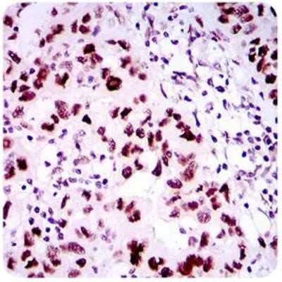 Immunohistochemistry-Paraffin: 53BP1 Antibody (6B3E10) - Azide and BSA Free [NBP2-80549] - Analysis of paraffin-embedded endometrial cancer tissues using 53BP1 Antibody with DAB staining. Image from the standard format of this antibody.