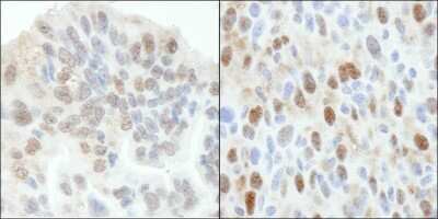 Immunohistochemistry-Paraffin: 53BP2 Antibody [NB100-2859] - Sample: FFPE section of human ovarian carcinoma (left) and mouse squamous cell carcinoma (right). Antibody: Affinity purified rabbit anti-ASPP2 used at a dilution of 1:5,000 (0.2ug/ml) and 1:1,000 (1ug/ml). Detection: DAB staining using Immunohistochemist