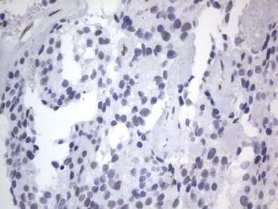 Immunohistochemistry: A2BP1 Antibody (OTI4F9) - Azide and BSA Free [NBP2-71965] - Analysis of Adenocarcinoma of Human breast tissue. (Heat-induced epitope retrieval by 1 mM EDTA in 10mM Tris, pH8.5, 120C for 3min)