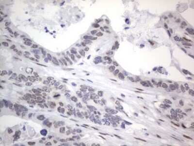 Immunohistochemistry: A2BP1 Antibody (OTI4F9) - Azide and BSA Free [NBP2-71965] - Analysis of Adenocarcinoma of Human colon tissue. (Heat-induced epitope retrieval by 1 mM EDTA in 10mM Tris, pH8.5, 120C for 3min)