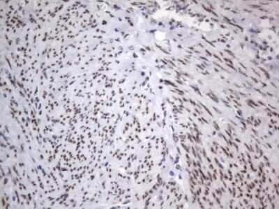 Immunohistochemistry: A2BP1 Antibody (OTI4F9) - Azide and BSA Free [NBP2-71965] - Analysis of Adenocarcinoma of Human endometrium tissue. (Heat-induced epitope retrieval by 1 mM EDTA in 10mM Tris, pH8.5, 120C for 3min)