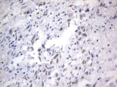 Immunohistochemistry: A2BP1 Antibody (OTI4F9) - Azide and BSA Free [NBP2-71965] - Analysis of Adenocarcinoma of Human ovary tissue. (Heat-induced epitope retrieval by 1 mM EDTA in 10mM Tris, pH8.5, 120C for 3min)