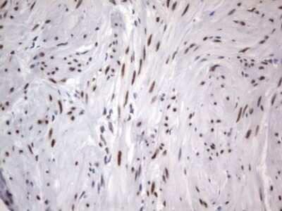 Immunohistochemistry: A2BP1 Antibody (OTI4F9) - Azide and BSA Free [NBP2-71965] - Analysis of Carcinoma of Human kidney tissue. (Heat-induced epitope retrieval by 1 mM EDTA in 10mM Tris, pH8.5, 120C for 3min)